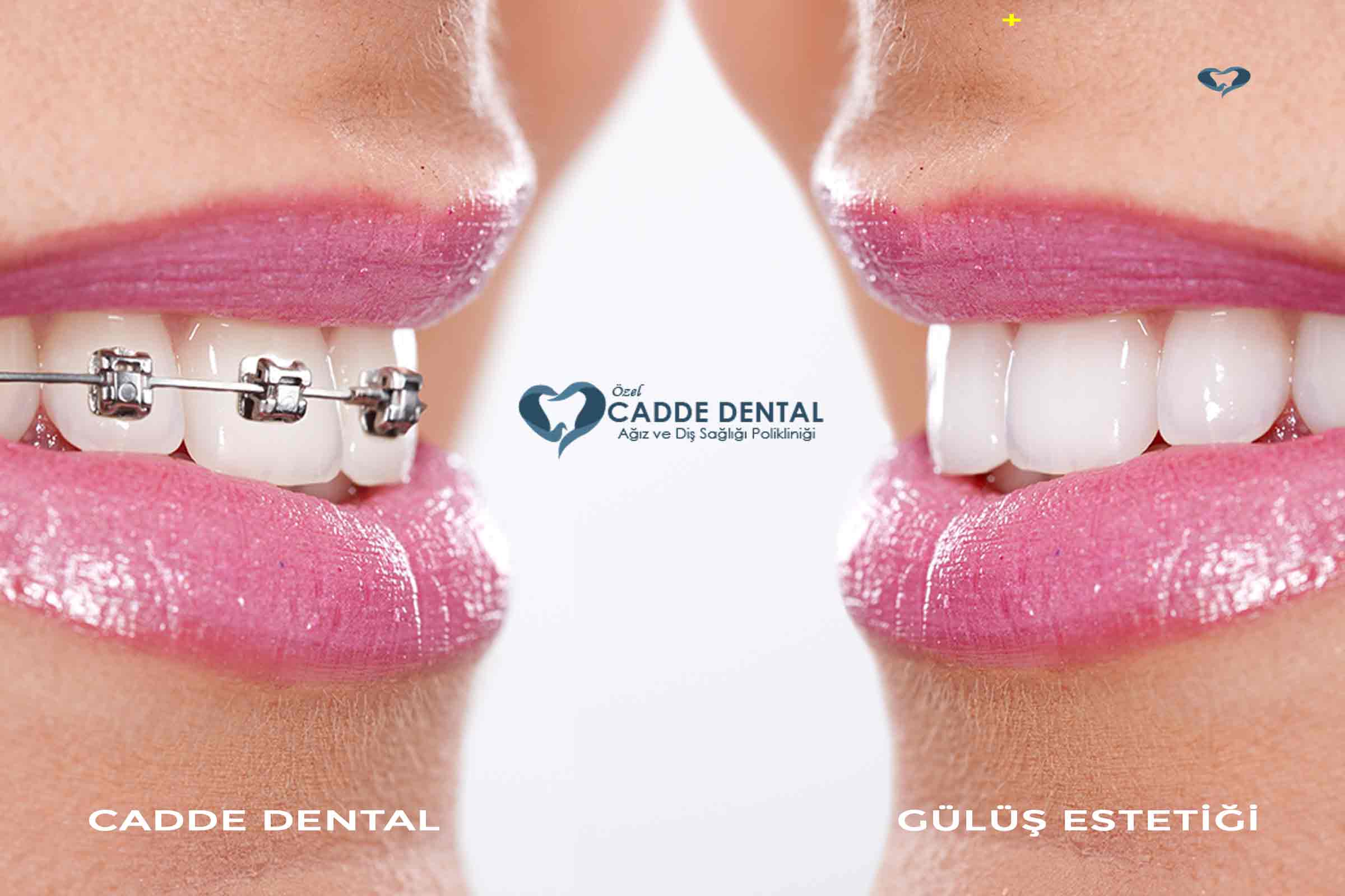 gülüş estetiği cadde dental