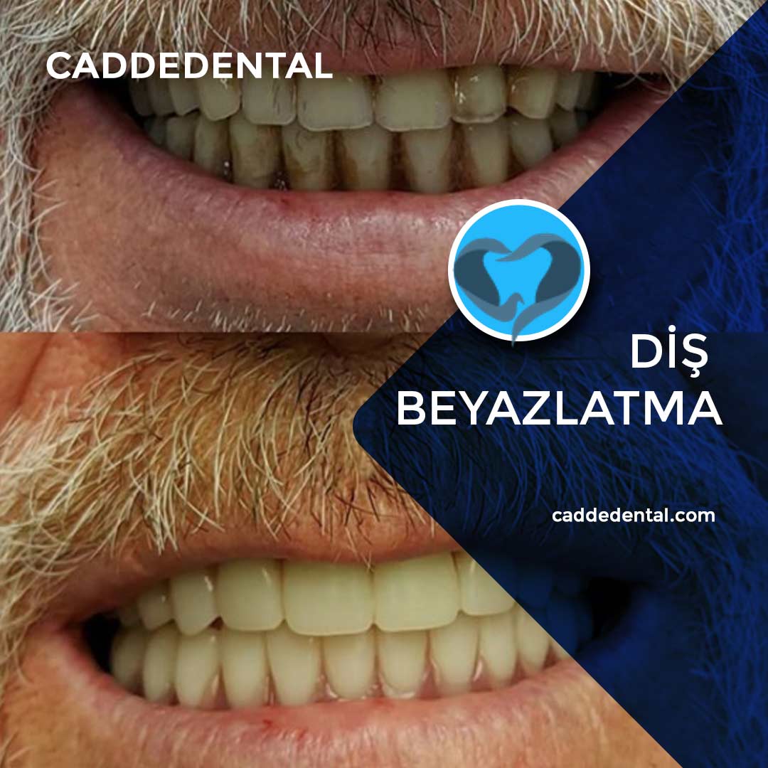 diş beyazlatma uygulaması izmir